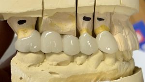 Tooth Replacement Albuquerque Dentist